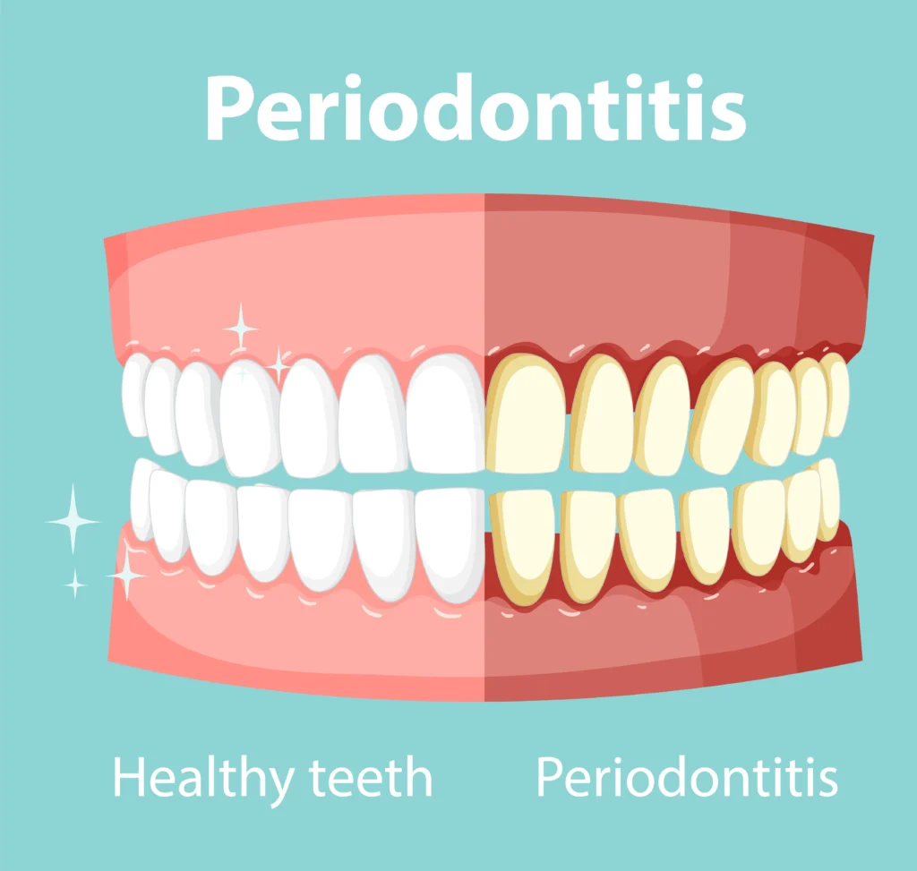Bleeding Gums: Causes, Treatment & When to See a Dentist