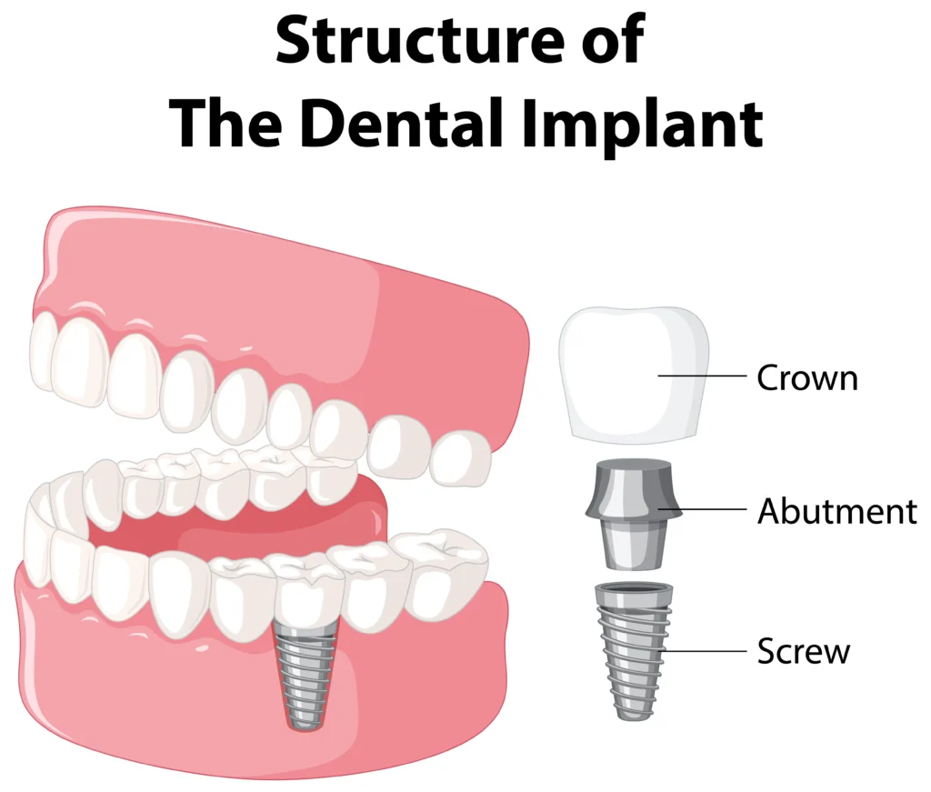 Dental Implants Cost in Thane: What You Should Know