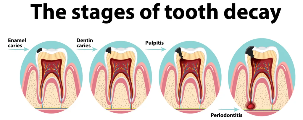 What Happens If You Delay Treating a Tooth Cavity? Stages, Risks and Treatment Options