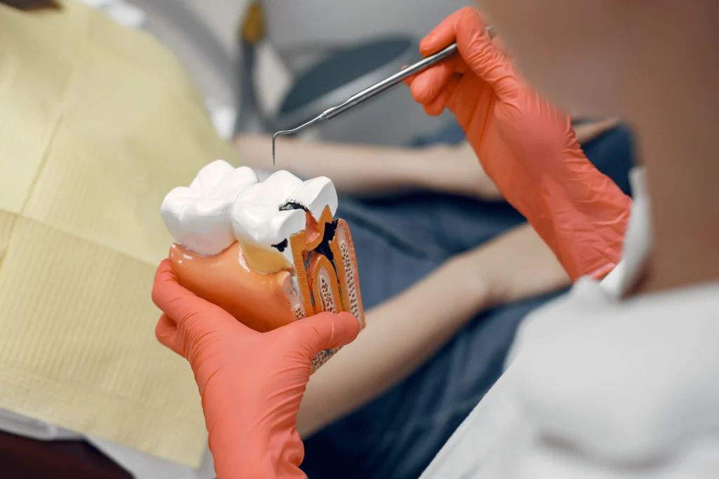Can You Get a Cavity Under a Dental Crown? Signs, Causes and Treatment